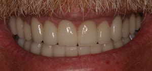 After having a smile makeover.