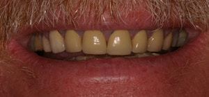 Before having a smile makeover