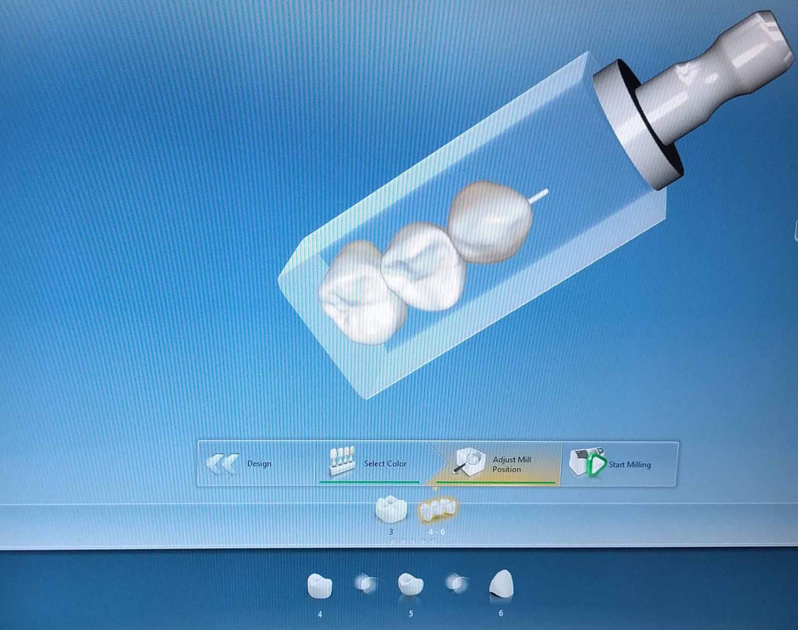 Dental bridge mockup using CEREC.