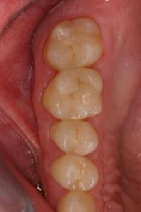 Teeth after dental bonding