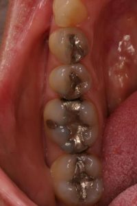 Teeth before dental bonding
