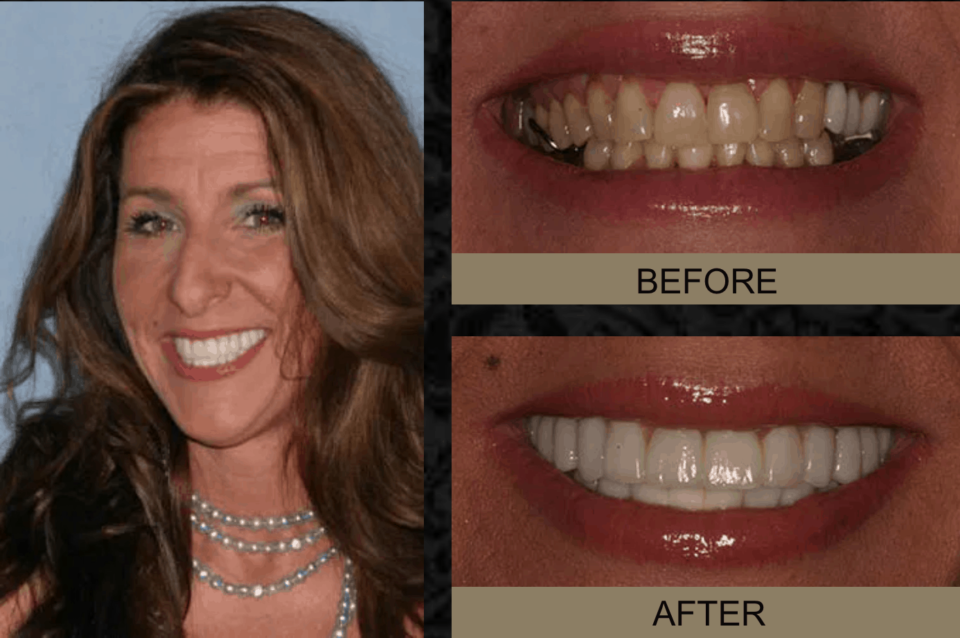 Dana - Before and After Smile