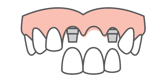 Single or Multi Tooth Dental Implant