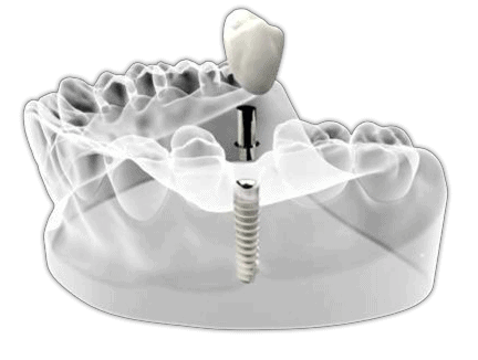 Dental Implants Chico CA