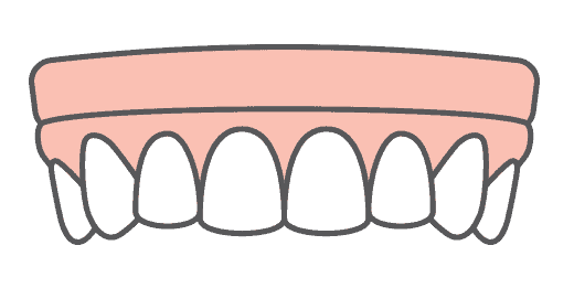 Full dental implant dentures