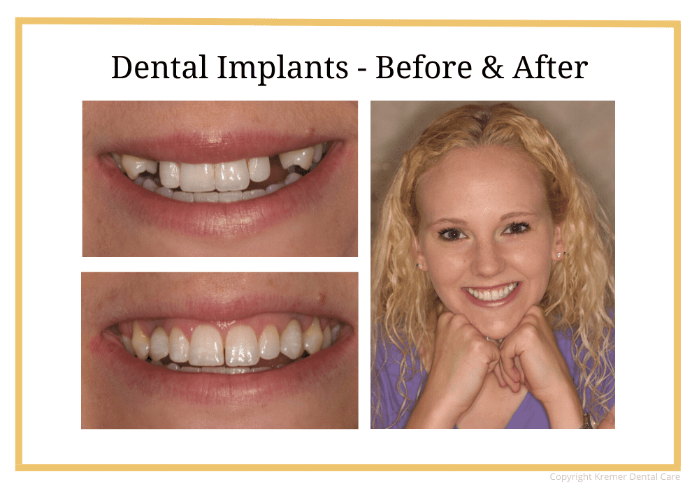 "Dental implants - Before & After" 