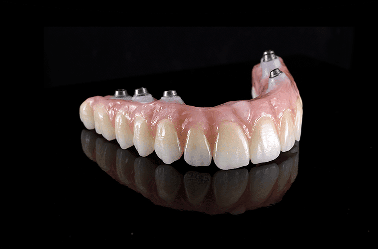 Tooth Extraction and Bone Graft
